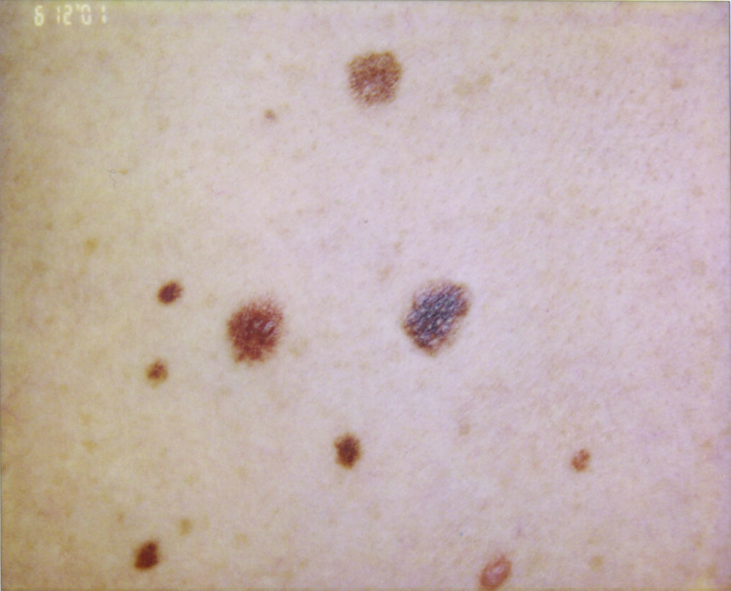Photograph of a group of moles of various sizes with one slightly darker and irregular developing into melanoma