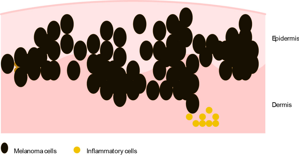 Illustration of the skin, showing melanoma cells in the epidermis layer on top and more melanoma cells in the dermis layer underneath with inflammatory cells