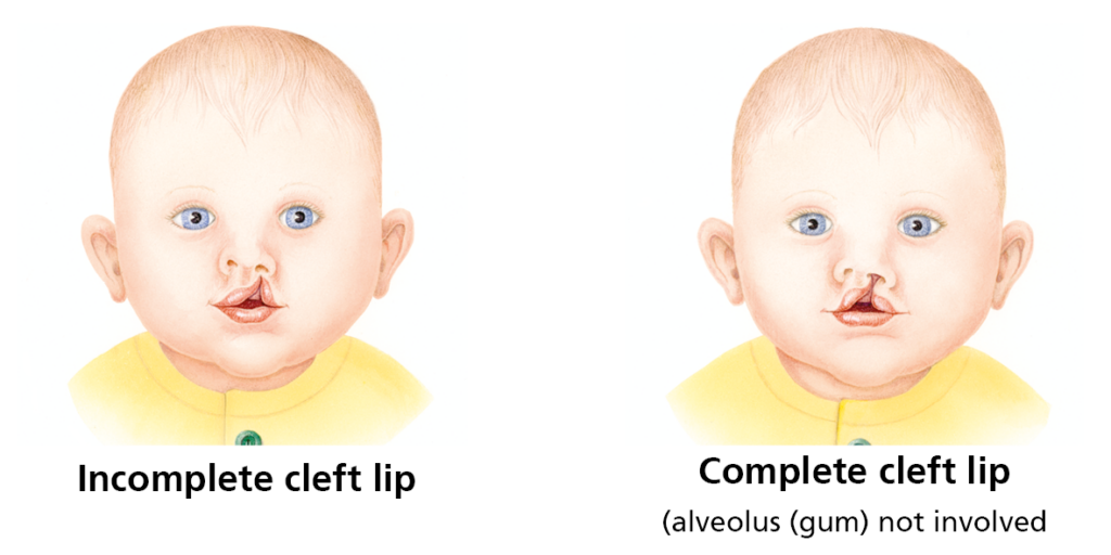 The first picture shows an incomplete cleft lip, the second picture shows a complete cleft lip, the alveolus (gum) not involved