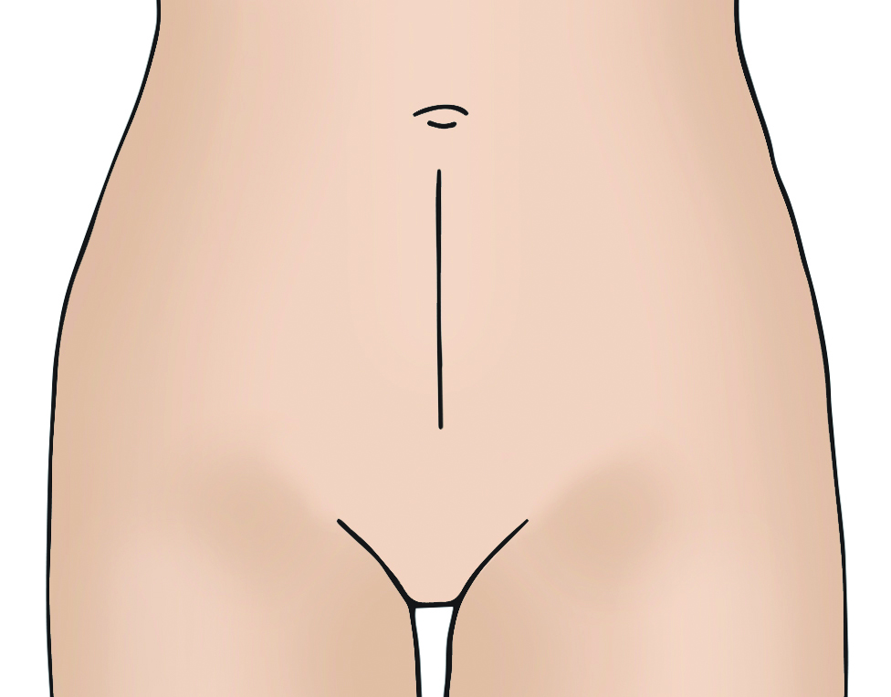 Illustration showing open hysterectomy midline incision.