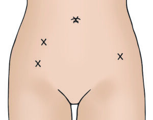 Illustration showing vaginal and vNOTEs hysterectomy incision site. 
This is scarless on the abdomen.