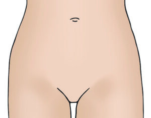 Illustration showing robotic hysterectomy incisions.