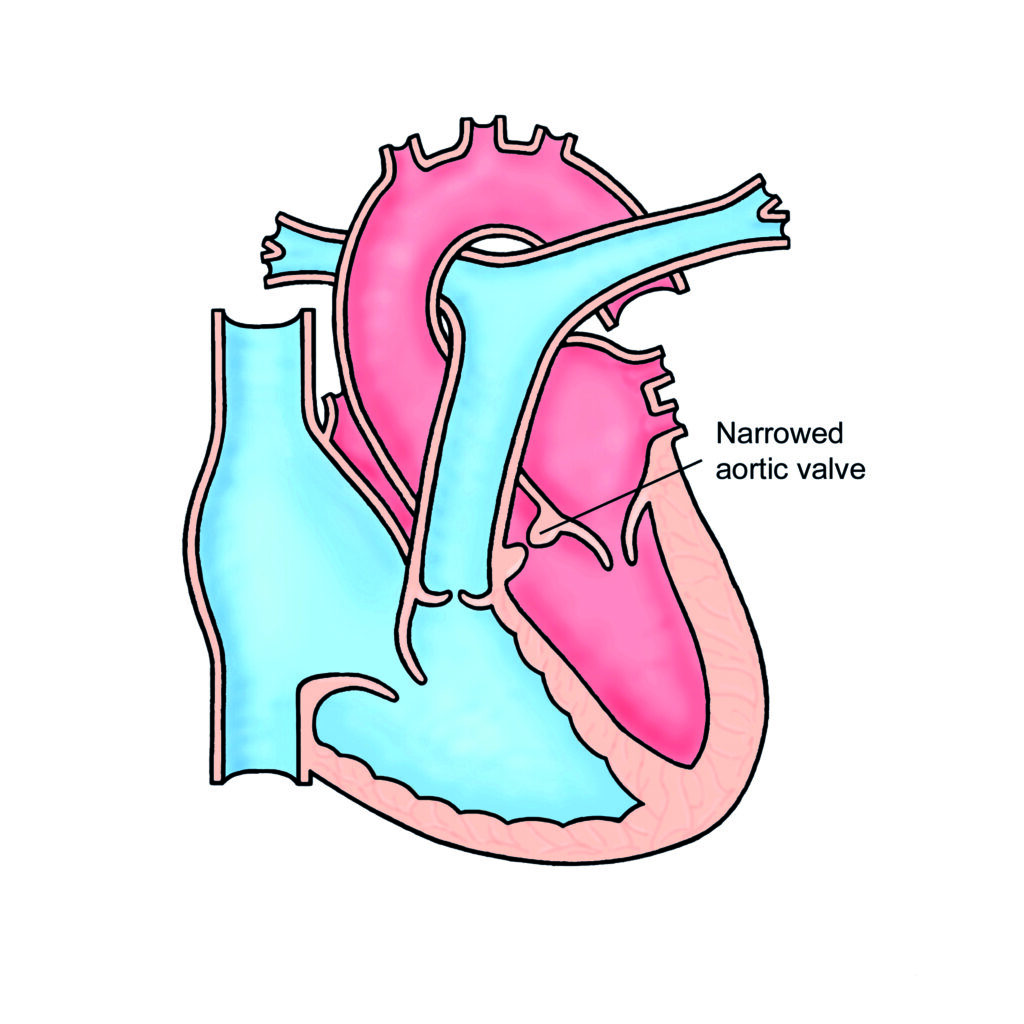 Image of a heart with Aortic Stenosis