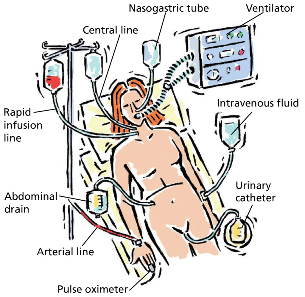 Illustration showing the intensive care equipment set up, to give you and your relatives an idea of the types of equipment and tubes that will be placed both before and during your operation. These include a Central line, Nasogastric tube, Ventilator, Intravenous fluid, Urinary catheter, Pulse oximeter, Arterial line, Abdominal drain and a  Rapid infusion line.