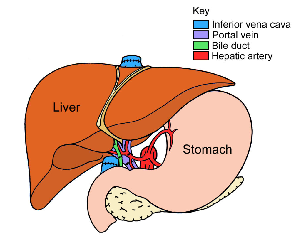 Illustration showing a full liver transplant.