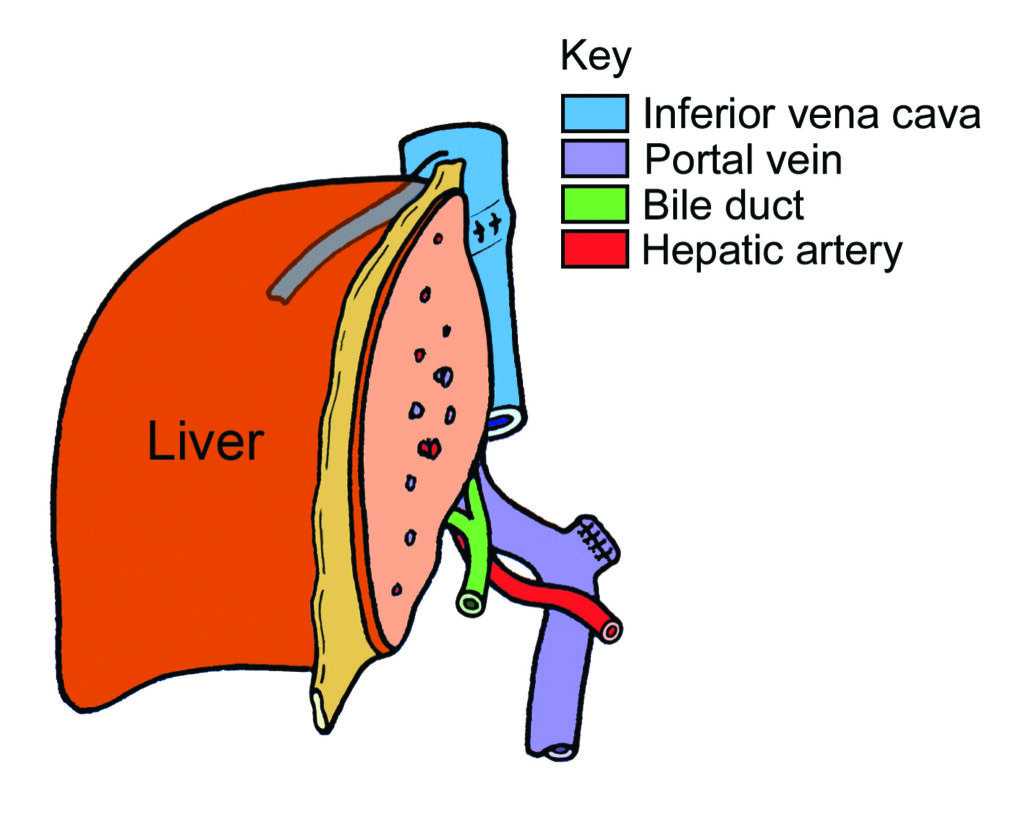 Illustration showing split liver transplant.