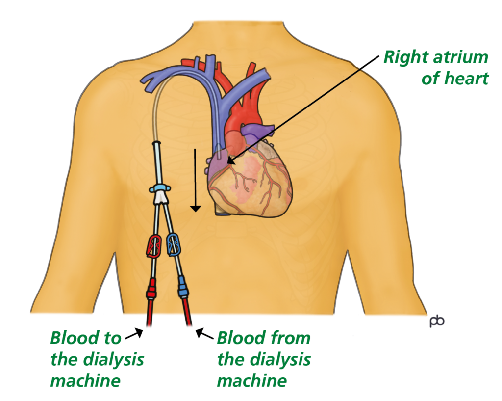 Illustration showing position of line tip at top of the heart.