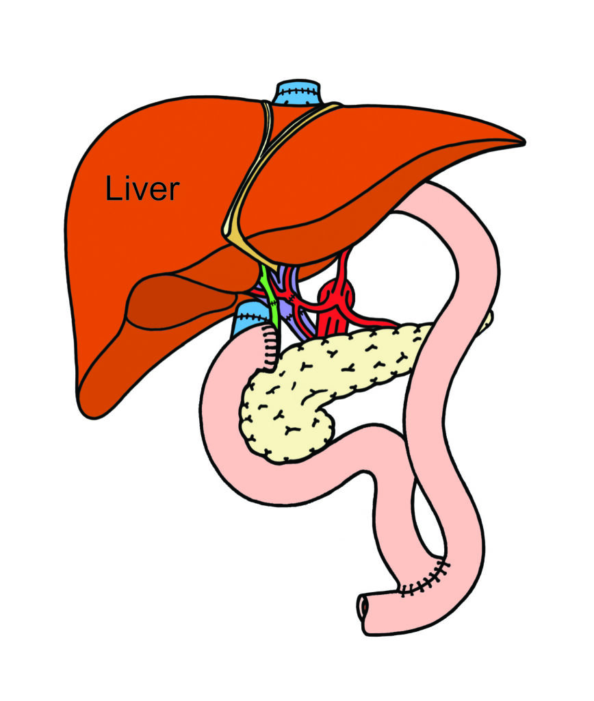 Illustration showing roux loop surgery.