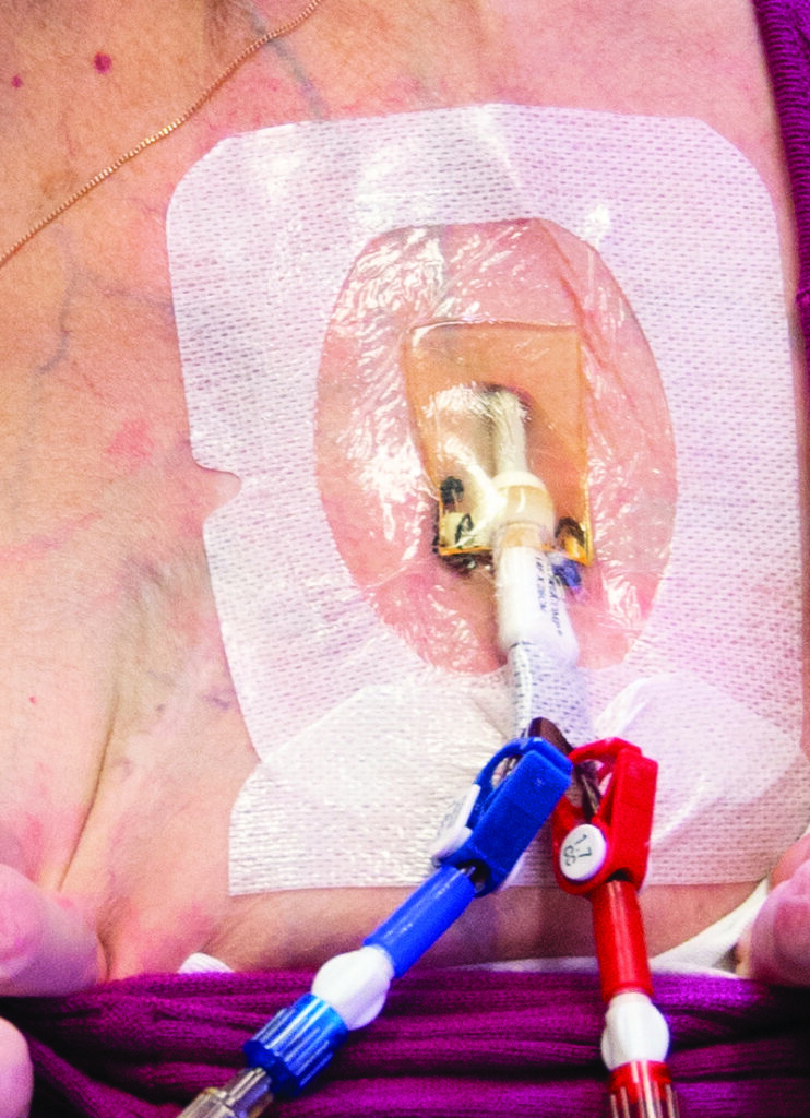 A photograph of a line coming out of skin at chest with clear dressing in place.