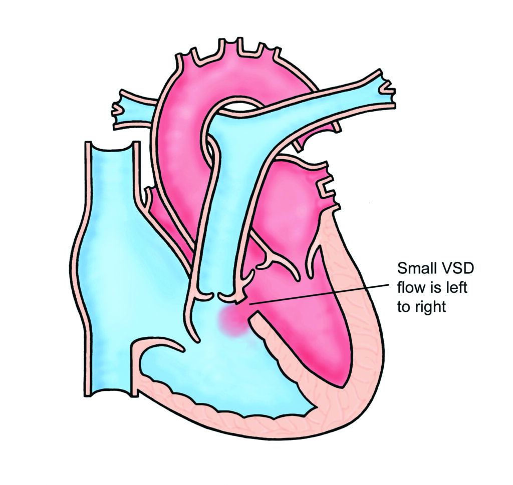 Image of a heart with a Small Ventricular Septal Defect (Perimembranous)