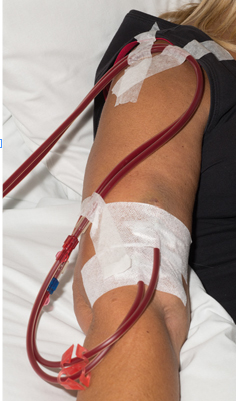 Photograph of a graft in the arm