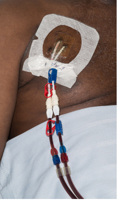 Photograph of a dialysis line inserted through the chest