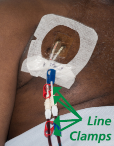 Photograph of a dialysis line inserted through the chest highlighting the clamps