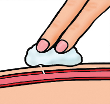 Illustartion of someone applying pressure to bleeding point and showing the layers of skin