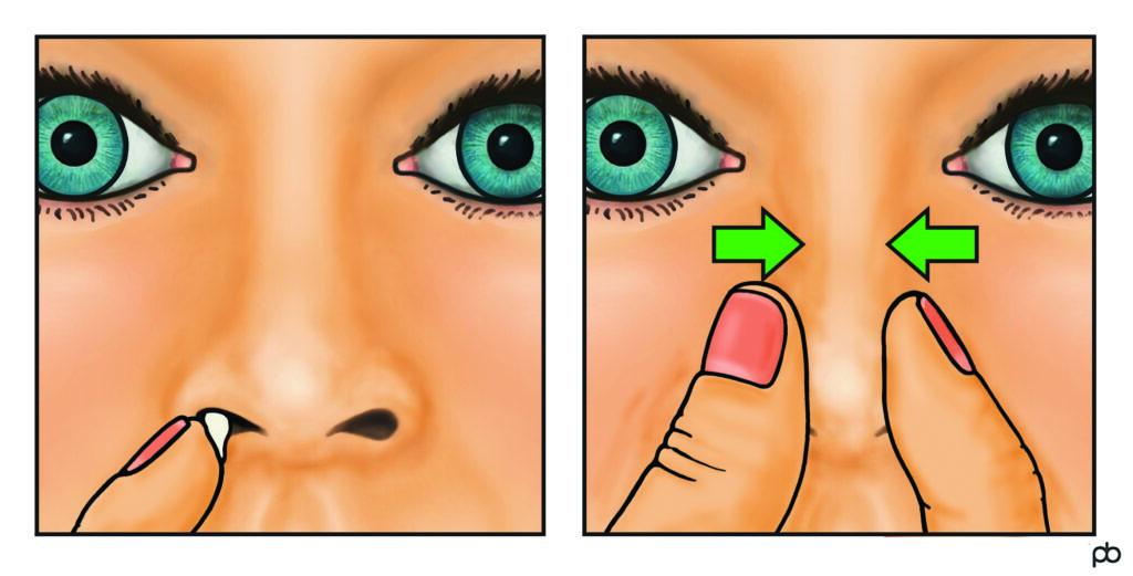 Illustration of cream being inserted to nostril (left image), and an Illustration of a nostril being squeezed to disperse cream (right image).