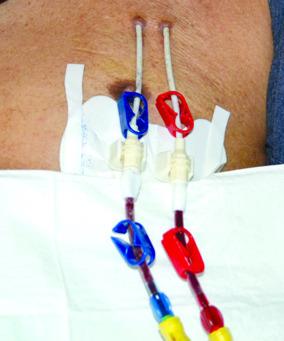 Photograph of two lines coming out of skin.