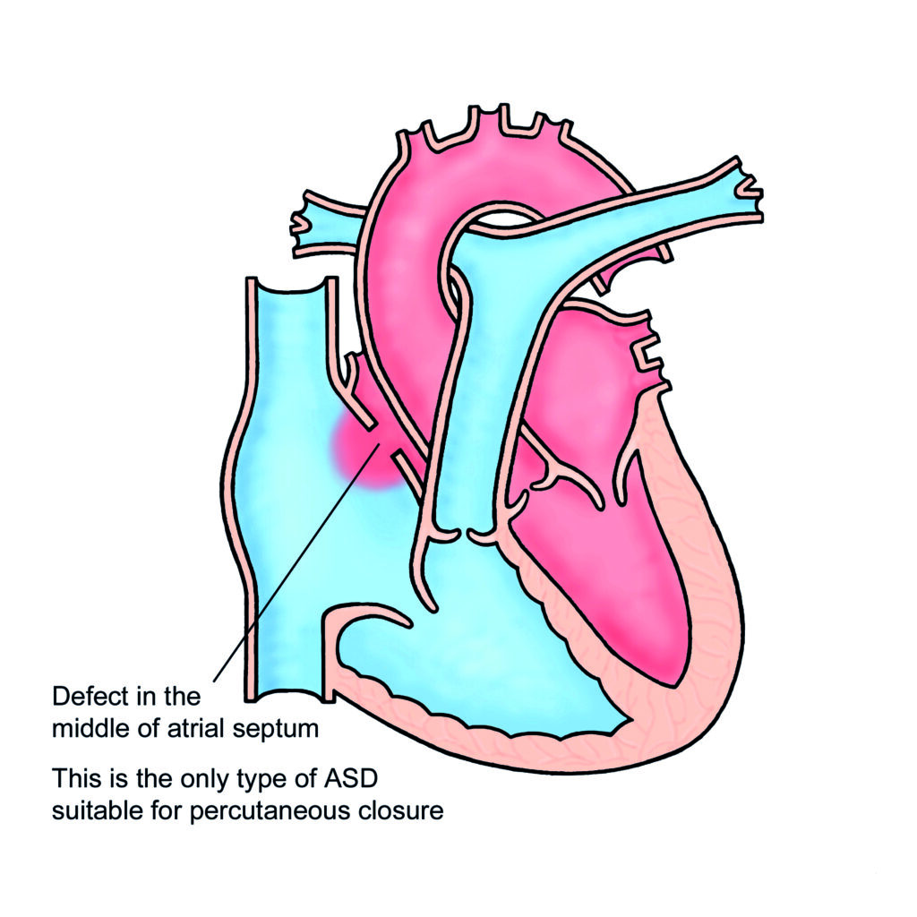 Illustration of a heart with artial septal defect (ASD).
