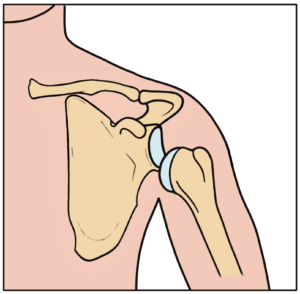 Dislocated shoulder joint