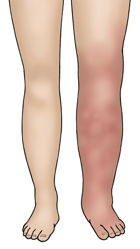 A leg with DVT (swollen and red), next to a leg without DVT.