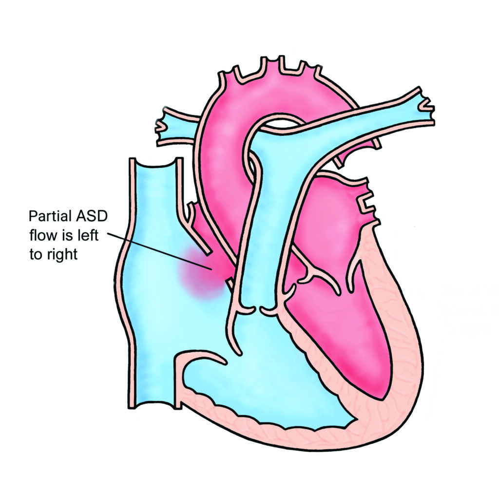 Image of a heart with Partial Atrio-Ventricular Septal Defect  
