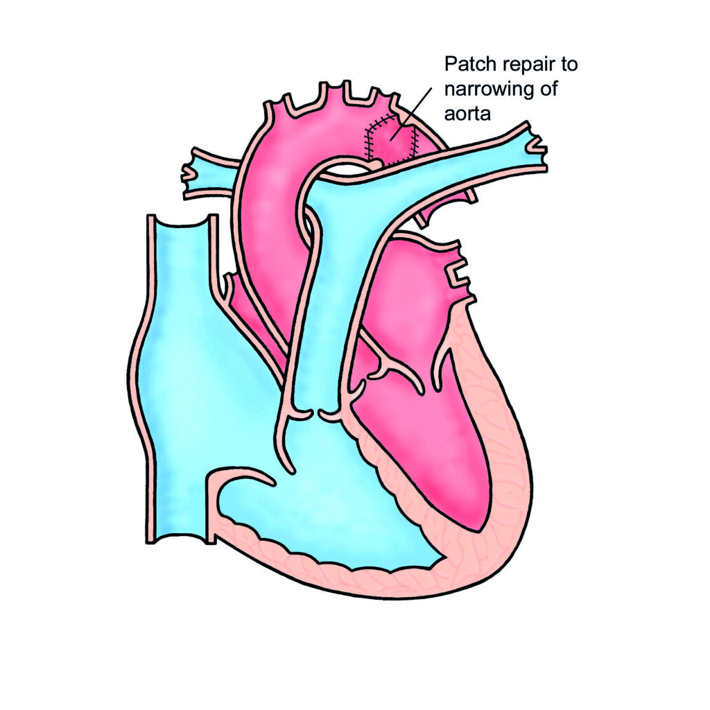 Image of a heart with Coarctation of the Aorta following repair