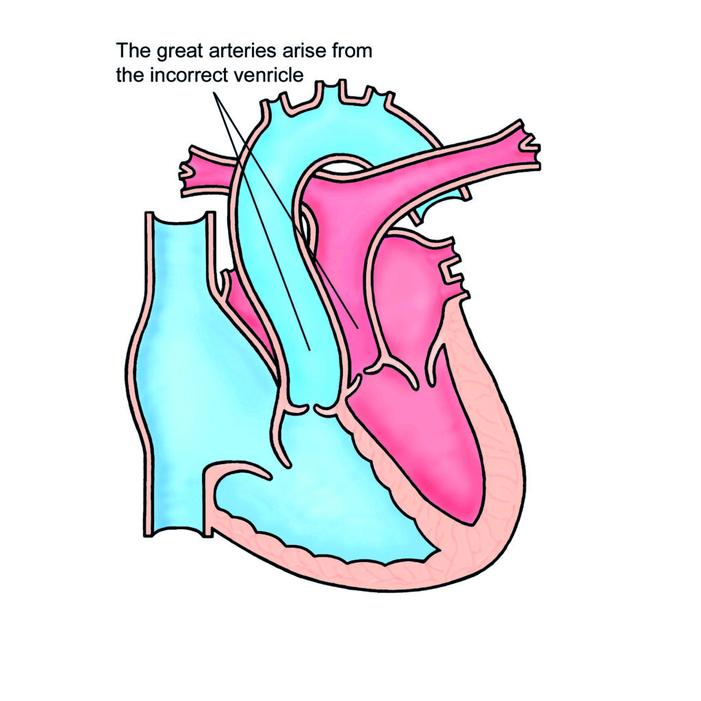 Image of a heart with Transposition of Great Arteries