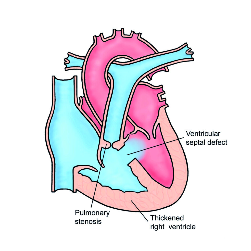 Image of a heart with Tetralogy of Fallot
