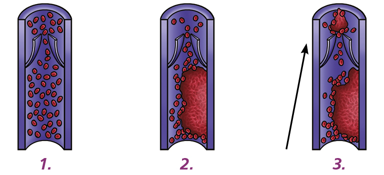 Three illustrations: 1: Normal blood flow in vein. 2: A clot has formed in the vein. 3: A part of the clot has broken off in the vein.