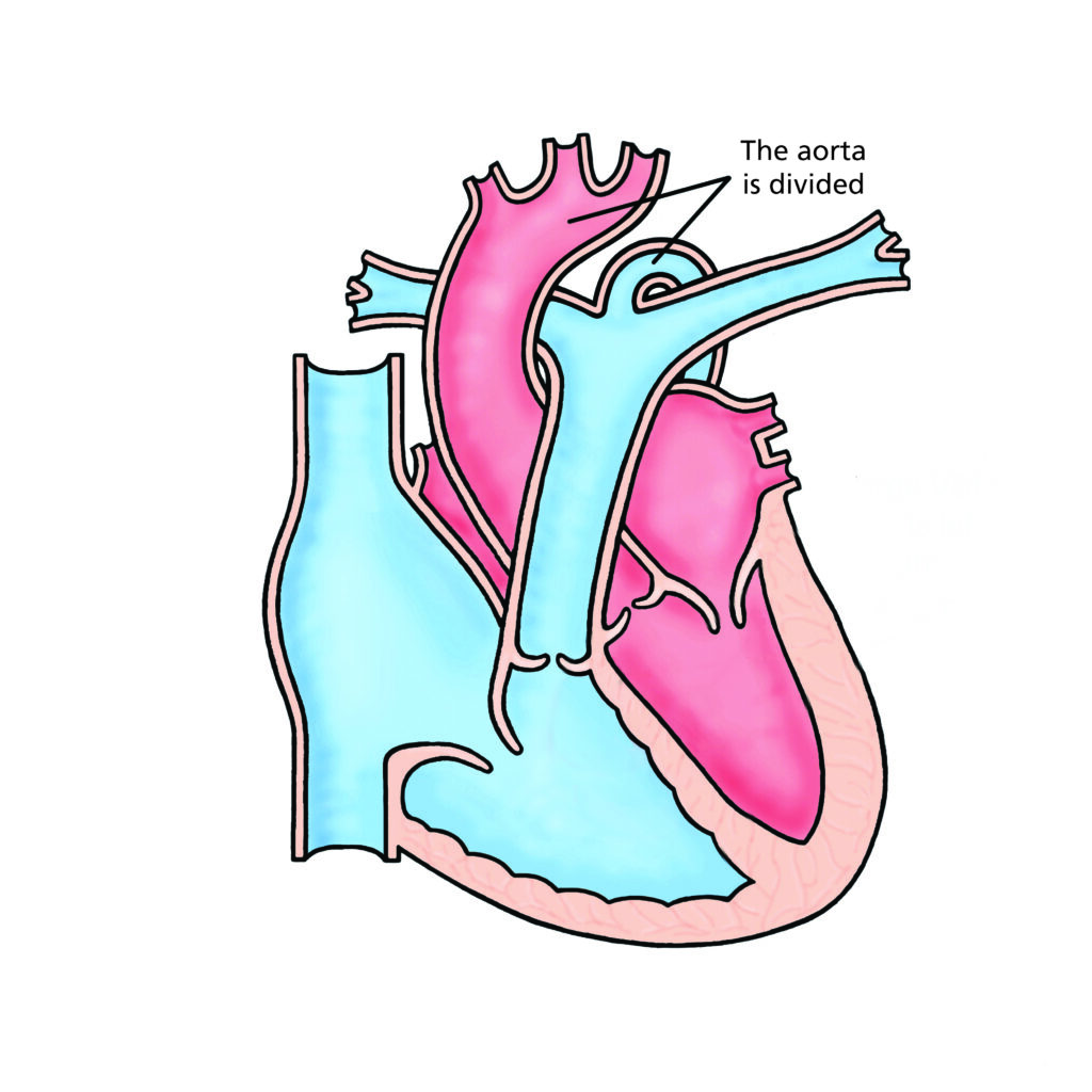 Image of a heart with interrupted aortic arch 