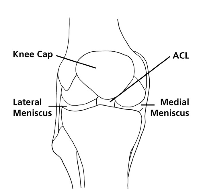 Diagram of a knee, showing the Knee cap, Lateral meniscus, ACl and Medial meniscus.