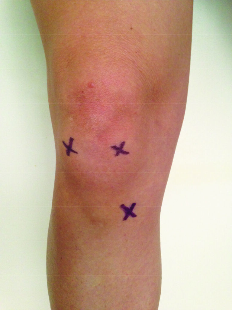 Photograph of a knee, showing incision sites.