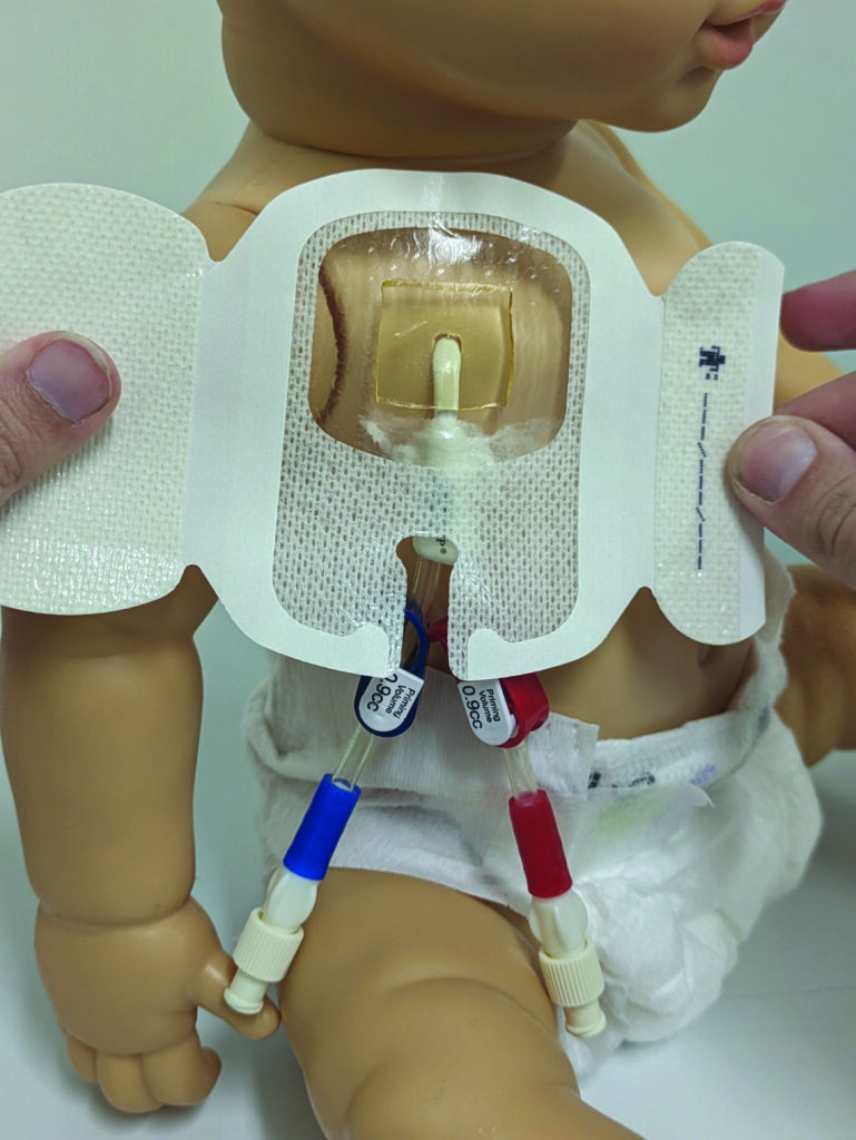 Image E. Apply a dressing ensuring the line site is covered.