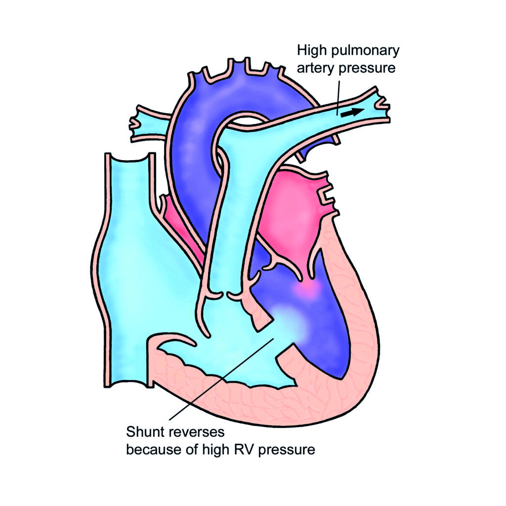 Eisenmenger Syndrome 
with VSD.