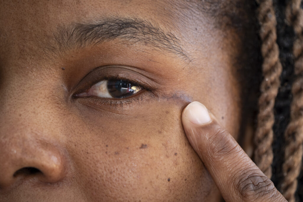 An image of Ruvimbo the patient pointing to a small scar left by the procedure next to her left eye.