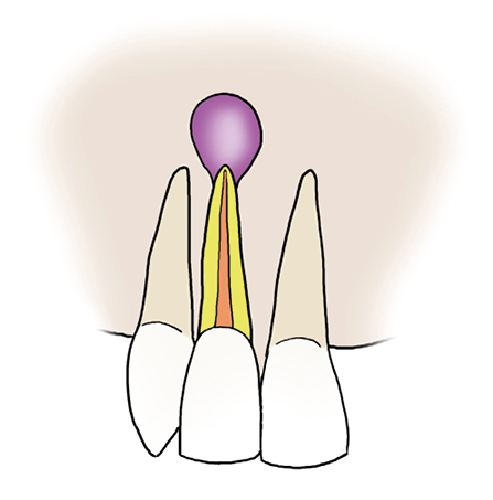 Illustration of the infected root apex of a tooth.