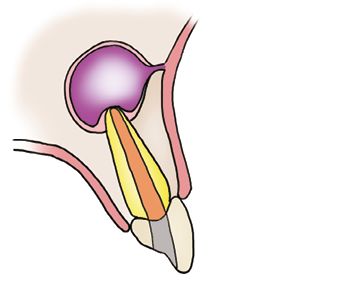 Illustration of a root filled tooth with infection at the tip of the root.