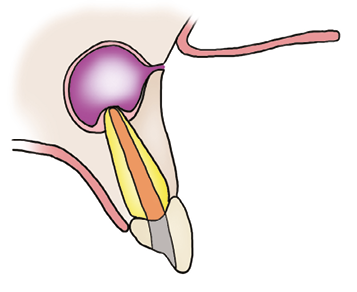 Illustration of the gum being peeled back to show the thin bone covering where the infection is.