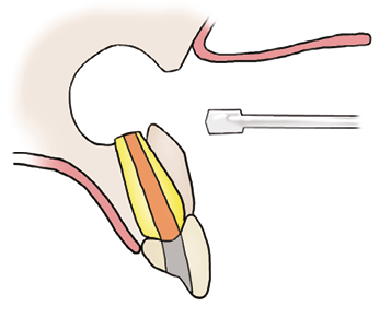 Illustration of the infected tip of the root being removed using a drill.
