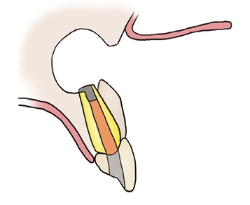 Illustration of the tip of the root being sealed with a special filling material.