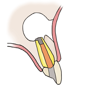 Illustration of the gum stitched back in place.