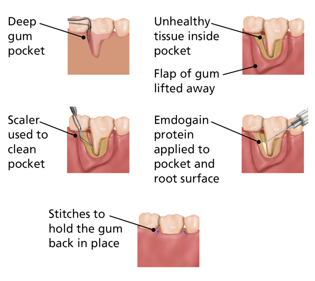 Illustrations of regenerative surgery procedure:
1. Deep gum pocket.
2. Unhealthy tissue inside pocket. Flap of gum lifted away.
3. Scaler used to clean pocket.
4. Emdogain protein applied to pocket and root surface.
5. Stitches to hold the gum back in place.