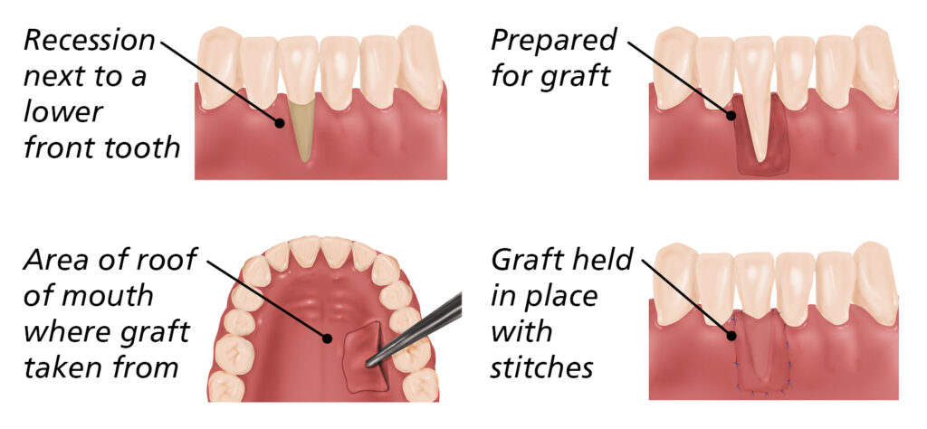 Illustration showing process of free gingival grafts:
1. Recession next to a lower front tooth.
2. Prepared for graft.
3. Area of roof of mouth where graft taken from.
4. Graft held in place with stitches.