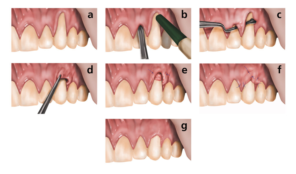Illustrations of 'tunneling' connective tissue graft surgery procedure.