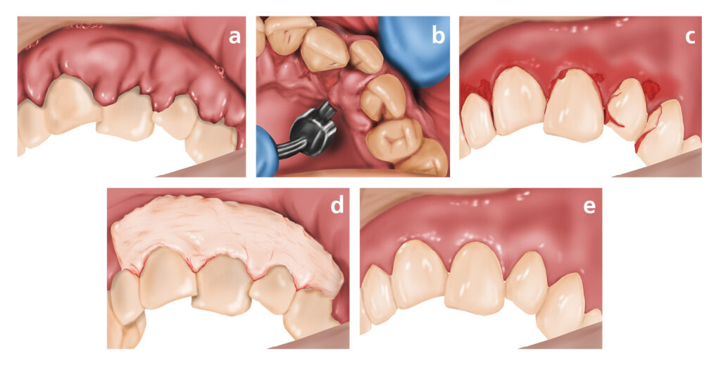 Illustration of Gingivectomy surgical procedure stages.