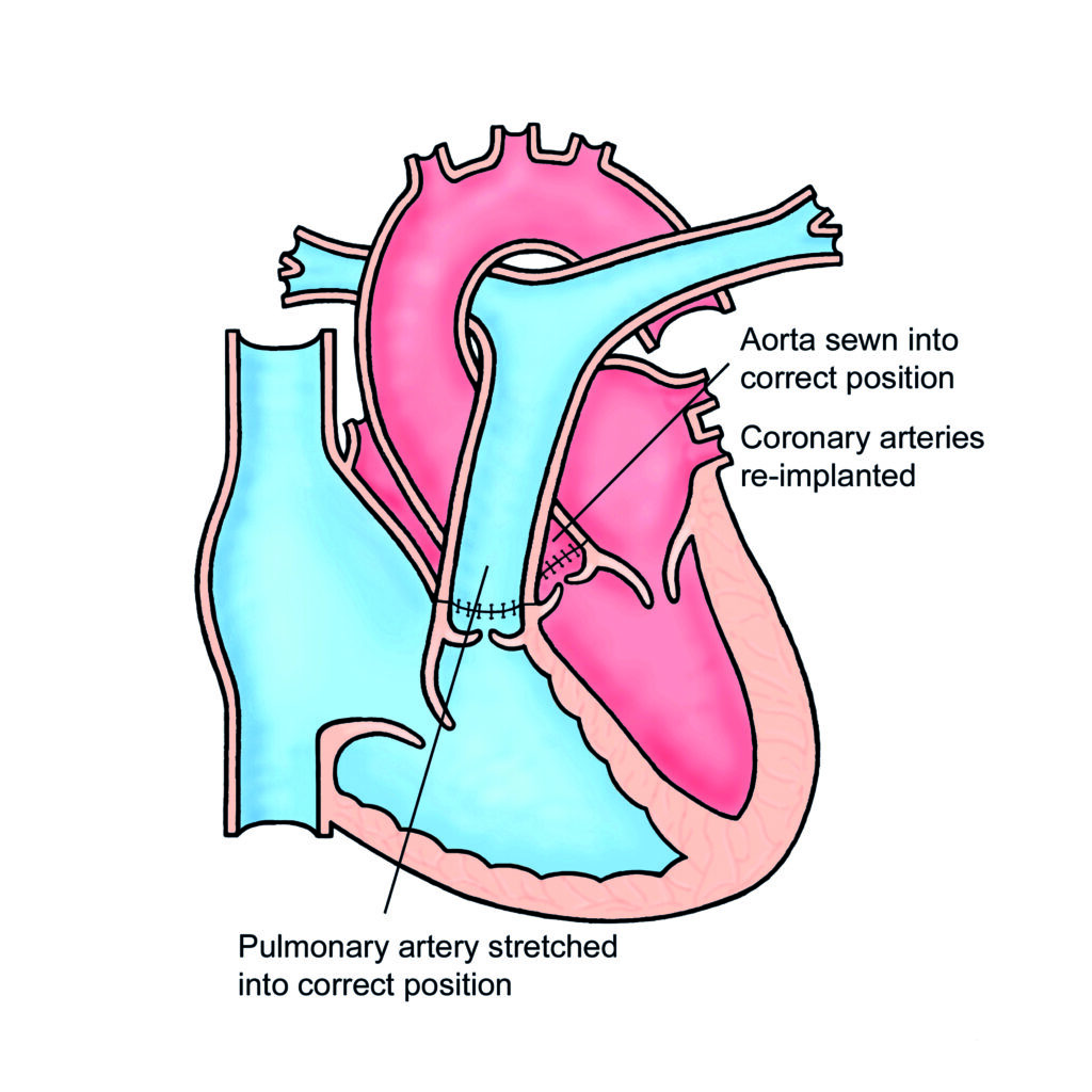 Image of a heart with Transposition of the great arteries (TGA).