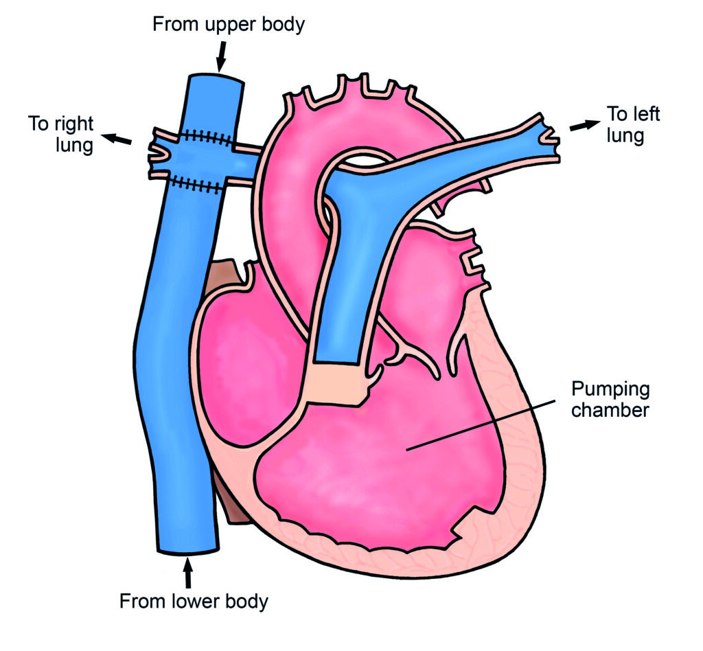 Illustration of a heart with Fontan Circulation.