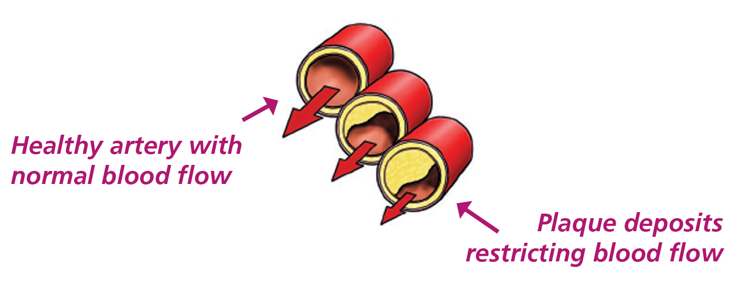 Illustration of the coronary arteries showing healthy arteries and arteries blocked by plaque deposits