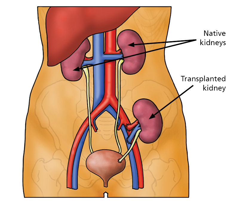 Anatomical illustration showing the native kidneys still in place and the transplanted kidney down towards the groin.