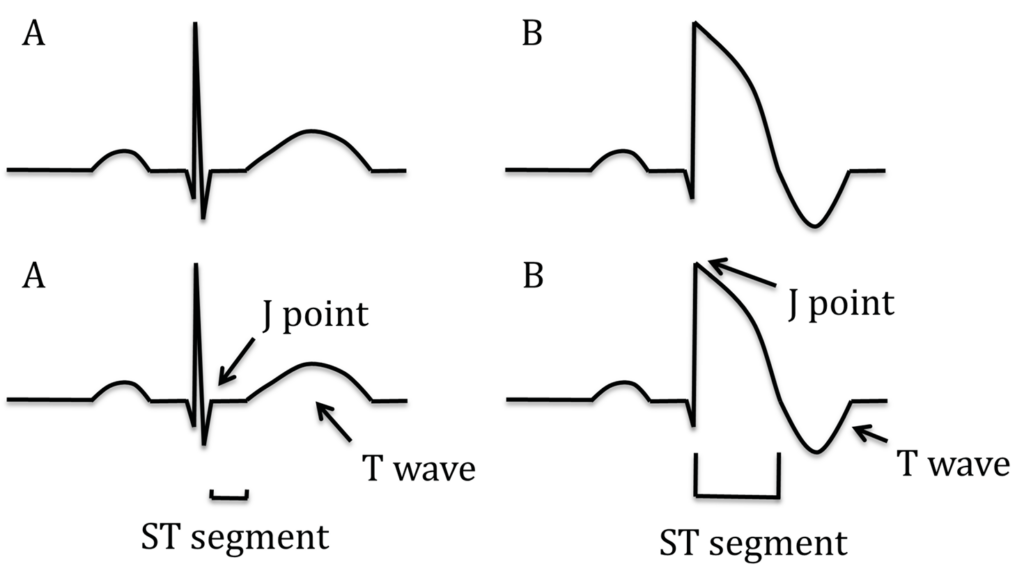 Figure 2 Image showing a normal ECG (A) and a Brugada ECG pattern (B)