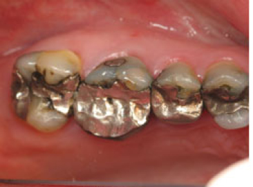 Before full crowns shows old failing amalgam restorations.